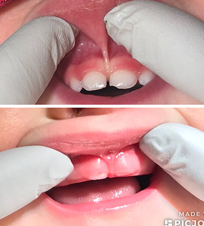 baby teeth care